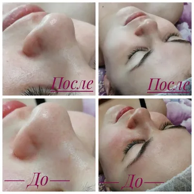 Прибор для чистки лица Yamaguchi Ultrasonic Face Skin Care купить