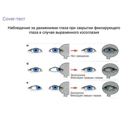 Аппаратное лечение косоглазия у детей на синоптофоре в Санкт-Петербурге