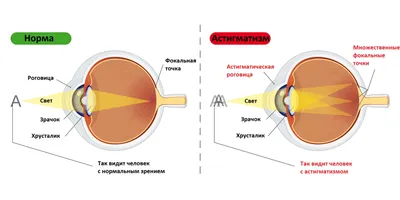 Расфокусировка зрения | Оптика Makaroff Optics | Дзен