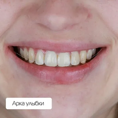 Коррекция десневой улыбки Ботоксом: обзор от Шестаковой