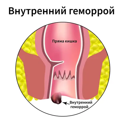 Геморрой у женщин - симптомы и лечение - диагностика геморроя