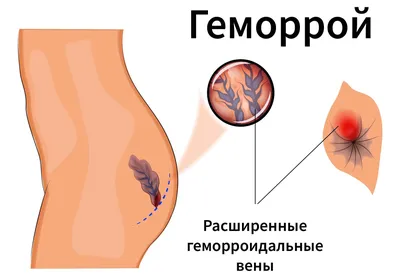 Внутренний геморрой: симптомы заболевания, признаки, стадии развития,  лечение