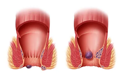 Геморрой лечение геморроя у мужчин и женщин в Москве цена в Клинике ABC