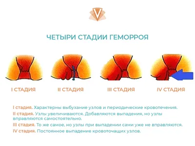 Наружный геморрой - причины и методы лечения