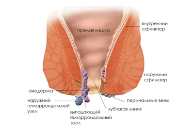 Лечение геморроя - Медицинский центр \"Мирт\"