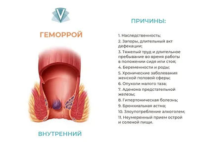 Лечение геморроя – лучшие клиники в Москве • Русский Доктор