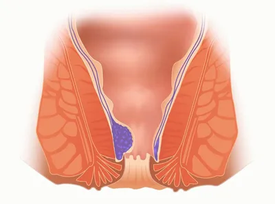 Эффективное лечение внутреннего геморроя - блог Виртус