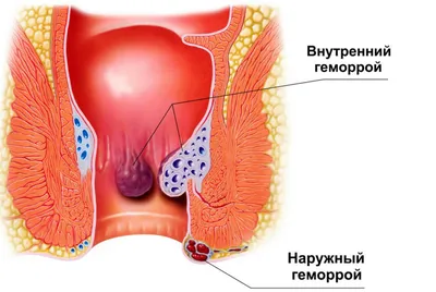 Геморрой - симптомы, лечение, причины и профилактика геморроя - Гармония