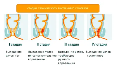 Эффективное лечение внутреннего геморроя - блог Виртус