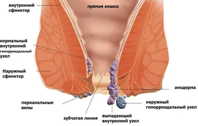 Внутренний геморрой - причины, диагностика и лечение