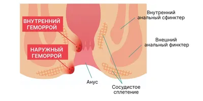 Геморрой: фото, симптомы, в т.ч. при беременности; лечение