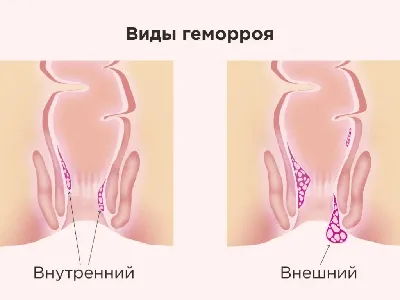 Геморрой: что такое? Как бороться? - статьи от компании Еламед