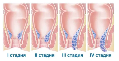 Геморрой после родов: лечение, что делать при грудном вскармливании,  симптомы, причины, профилактика в домашних условиях