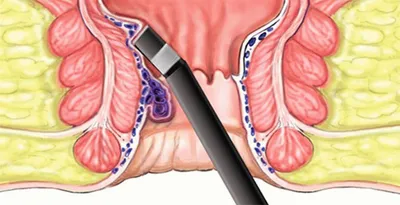 Эффективное лечение геморроя в Ростове-на-Дону