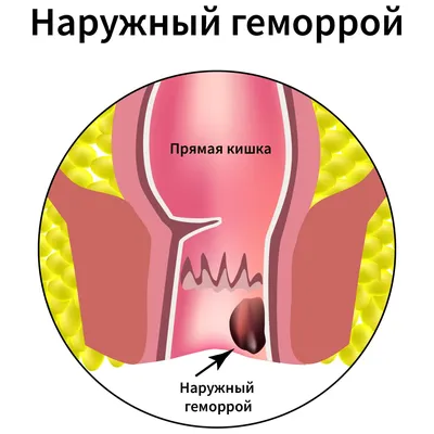 Zhigenduanwan шарики для лечения геморроя (id 88979037), купить в  Казахстане, цена на Satu.kz