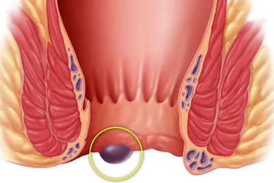 Геморрой: причины, симптомы, стадии, виды, осложнения, профилактика