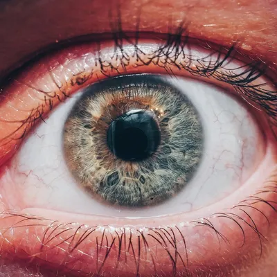 Что такое амблиопия (ленивый глаз): лечение в Дом Оптики