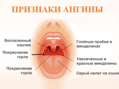 Щекочет в горле и вызывает кашель: как выяснить причины и успокоить  щекочущий кашель у взрослых и детей