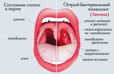 Гортань Горла Горла Глотки Язык Вирусный Лингит Воспаление Миндалин Рот  стоковое фото ©yennefer.1c@gmail.com 281594088