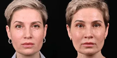 Липофилинга лица фото до и после | Клиника Доктора Гришкяна |