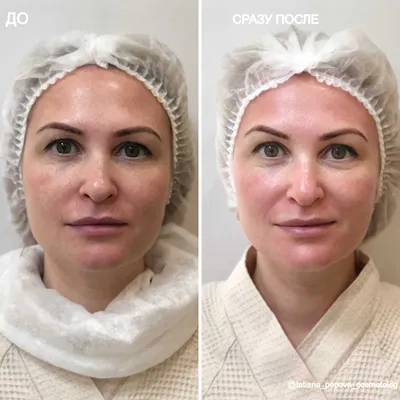 Мезотерапия Кожи Лица И Тела в Донецке | инъекционная косметология | Anna  Grigorieva beauty doctor