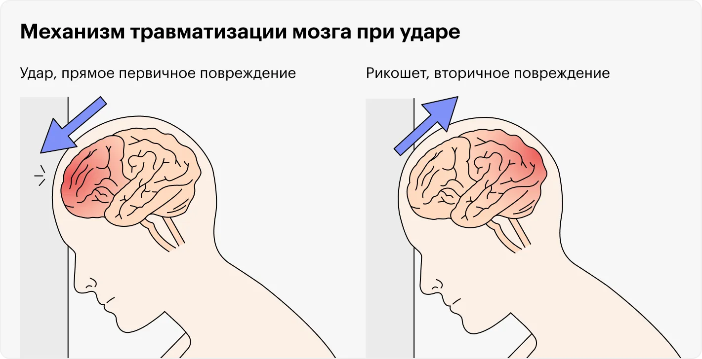 Ударилась головой что делать. Сотрясение головы и головного мозга. Клинические проявления сотрясения. Травмы головы сотрясение. Что если сильно ударился головой.