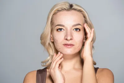 Пигментация на лице: личный опыт, фото и комментарий врача | Beauty Insider