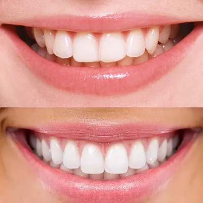 3-dent - Ортодонт об улыбке👌 Улыбка идет всем – это символ открытости и  доброжелательности. Но есть ли критерии той самой правильной и красивой  улыбки? 😊 Что на эту тему говорят ортодонты: ⠀