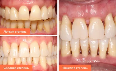 Пародонтоз лечение, симптомы, причины, профилактика