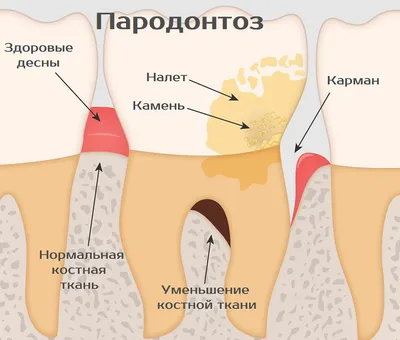 Имплантация при пародонтозе и пародонтите | Статьи на сайте Bredent