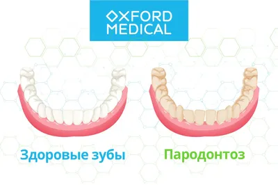 Современное лечение пародонтоза