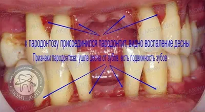 Пародонтоз лечение в Киеве: цена на лечение пародонтоза в стоматологии  клиники Оксфорд Медикал