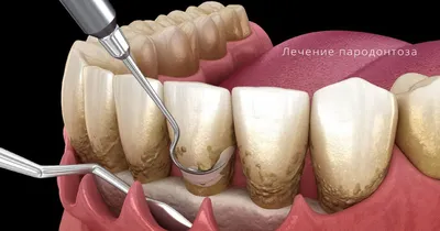 Лечение пародонтоза и пародонтита в Краснодаре по низкой цене |  Стоматология «Для Семьи»