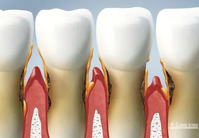 Стоматология Ориен-дента - Пародонтит и пародонтоз — слова похожи, а вот  заболевания разные. Объясняю разницу ниже, жмите ❤️ . Пародонт — это единая  система тканей, окружающих зуб. В нее входят дёсны, костная