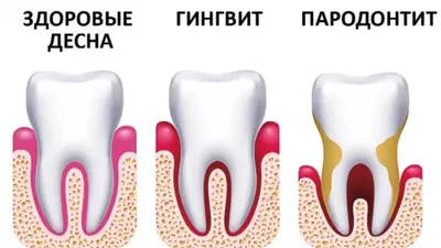 Пародонтоз виды и симптомы, лечение пародонтоза в Москве