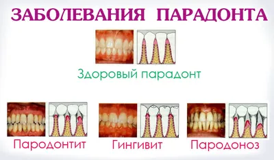 Лечение воспаления десён, пародонтоза и пародонтита | Оланко Бровары Киев