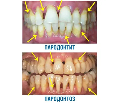 Как лечить пародонтоз: признаки, симптомы