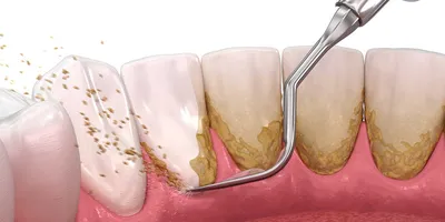 Пародонтоз - симптомы, лечение и профилактика заболевания