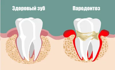 Имплантация зубов при пародонтозе | НК Клиник