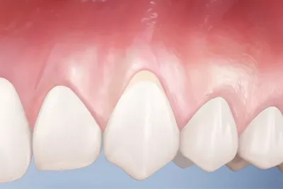 Пародонтоз: причины появления, симптомы и эффективное лечение заболевания в  стоматологической клинике