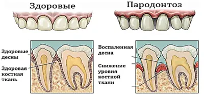 Пародонтоз: фото до и после заболевания. Причины и лечение