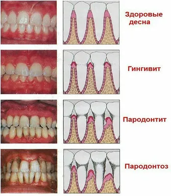 Как лечат пародонтоз в стоматологических клиниках? Профилактика и симптомы  пародонтоза