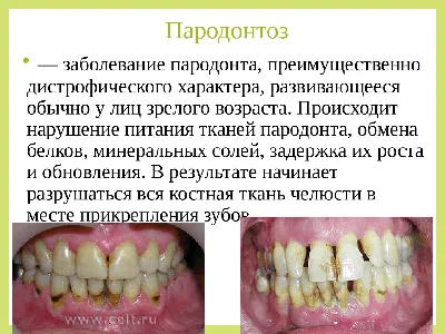 Лечение сложных форм пародонтоза и пародонтита в Санкт-Петербурге