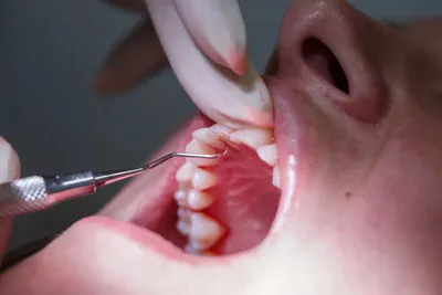 Пародонтит и... - Ош стоматолог Ортодонт Брекет | Facebook
