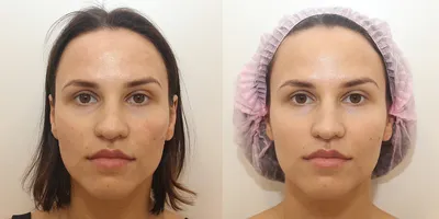 Пилинг лица - В клинике врачебной косметологии Reline