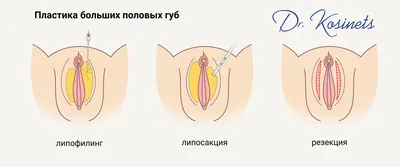 Липофилинг (увеличение) больших половых губ — Москва