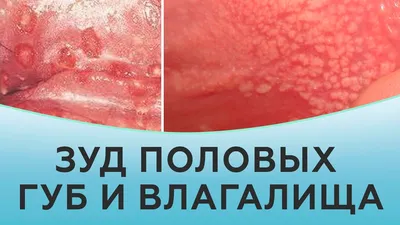 Плазмолифтинг интимной зоны - безопасный плазмолифтинг половых губ в Киеве  | Клиника Gold Laser
