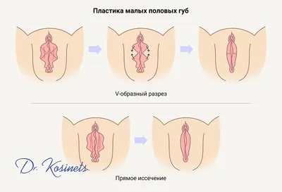 Лабиопластика – пластика половых губ