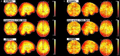 Ученые впервые зафиксировали изменения в мозге при лечении клинической  депрессии