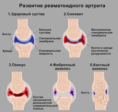 Ревматоидный артрит